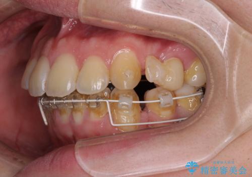 出っ歯と八重歯 目立たない裏側装置でスッキリとした口元にの治療中
