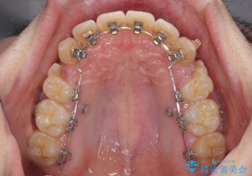 出っ歯と八重歯　目立たない裏側装置でスッキリとした口元にの治療中