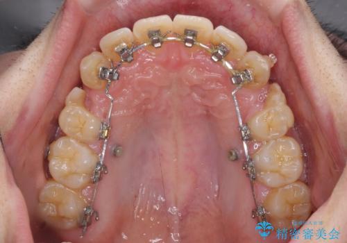 出っ歯と八重歯 目立たない裏側装置でスッキリとした口元にの治療中
