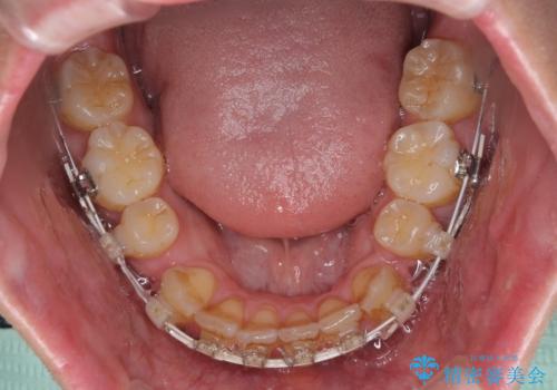 出っ歯と八重歯 目立たない裏側装置でスッキリとした口元にの治療中