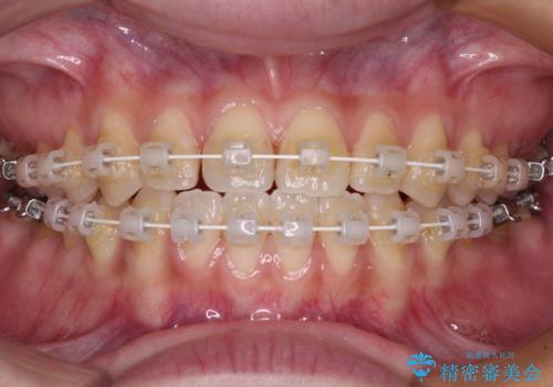 前歯のクロスバイトを治したい ワイヤー装置による矯正治療の治療中