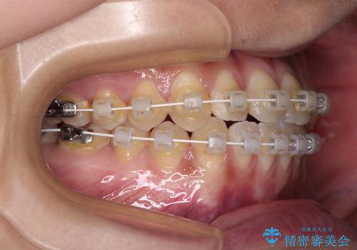 前歯のクロスバイトを治したい　ワイヤー装置による矯正治療の治療中