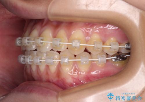 前歯のクロスバイトを治したい ワイヤー装置による矯正治療の治療中