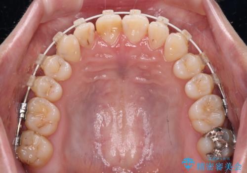 前歯のクロスバイトを治したい ワイヤー装置による矯正治療の治療中