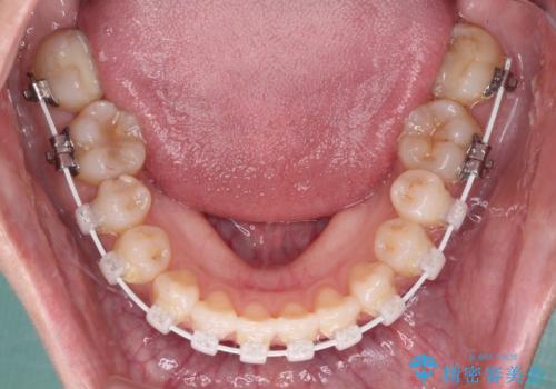前歯のクロスバイトを治したい　ワイヤー装置による矯正治療の治療中