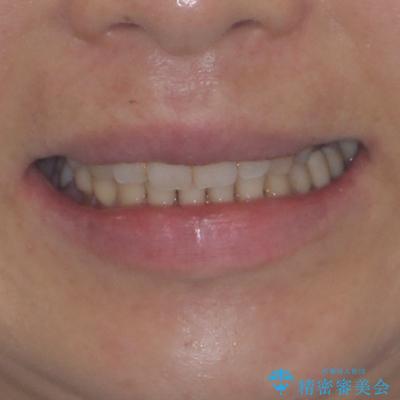 正中のズレと飛び出した前歯を改善 メタルブラケットでの抜歯矯正の治療後(顔貌)