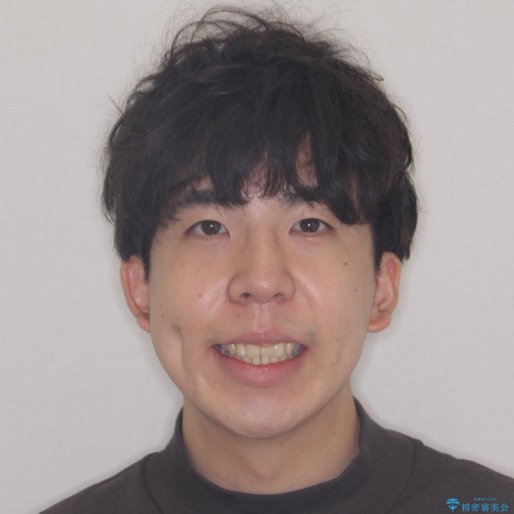 【モニター】後戻りで飛び出してきた前歯 ワイヤー装置での再矯正の治療前(顔貌)