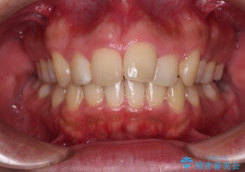 【モニター】後戻りで飛び出してきた前歯 ワイヤー装置での再矯正の治療前