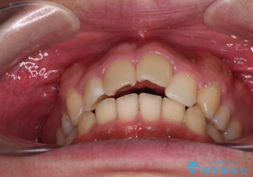 【モニター】後戻りで飛び出してきた前歯 ワイヤー装置での再矯正の治療前