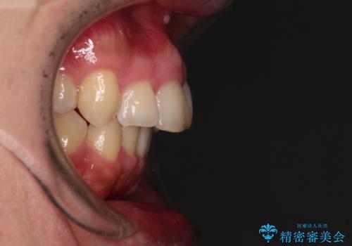 【モニター】後戻りで飛び出してきた前歯 ワイヤー装置での再矯正の治療前