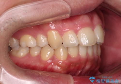 【モニター】後戻りで飛び出してきた前歯 ワイヤー装置での再矯正の治療前