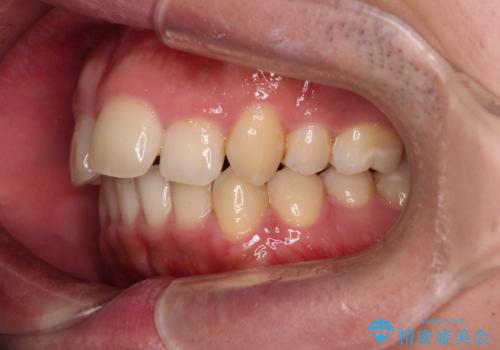 【モニター】後戻りで飛び出してきた前歯 ワイヤー装置での再矯正の治療前