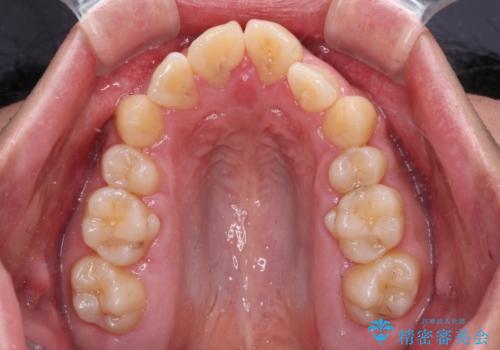 【モニター】後戻りで飛び出してきた前歯 ワイヤー装置での再矯正の治療前