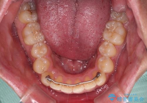 【モニター】後戻りで飛び出してきた前歯 ワイヤー装置での再矯正の治療前
