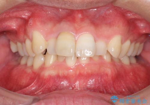 2級ディープバイト 遠心移動を伴うマウスピース矯正の治療前