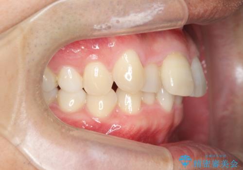 2級ディープバイト 遠心移動を伴うマウスピース矯正の治療前