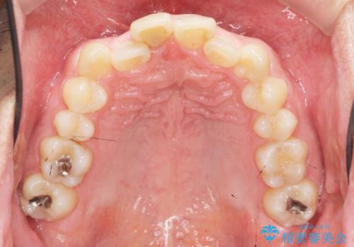 2級ディープバイト 遠心移動を伴うマウスピース矯正の治療前