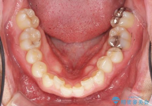 2級ディープバイト 遠心移動を伴うマウスピース矯正の治療前