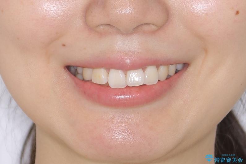 【再矯正】後戻りによるガタつきをマウスピースで改善!の治療前(顔貌)