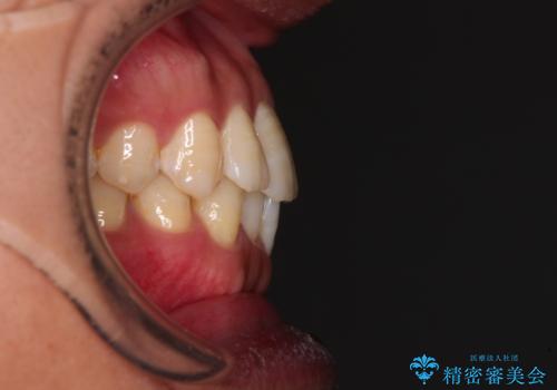 【モニター】楽して治したい メタルブラケットによる矯正治療の治療前