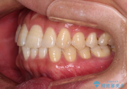 【モニター】楽して治したい メタルブラケットによる矯正治療の治療前