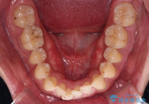 【モニター】楽して治したい メタルブラケットによる矯正治療の治療前
