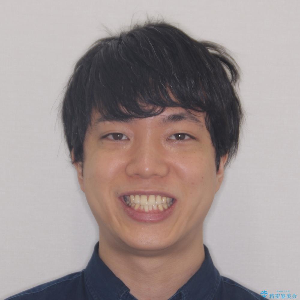 【モニター】楽して治したい メタルブラケットによる矯正治療の治療前(顔貌)