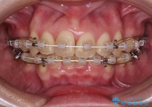 【モニター】横顔のシルエットをスッキリと ワイヤー装置による抜歯矯正治療の治療中