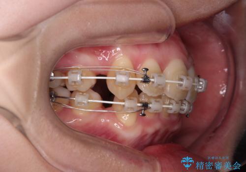 【モニター】横顔のシルエットをスッキリと ワイヤー装置による抜歯矯正治療の治療中