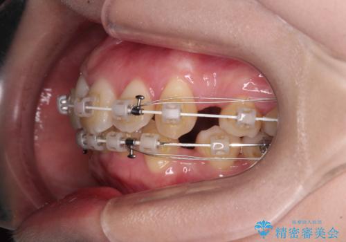 【モニター】横顔のシルエットをスッキリと ワイヤー装置による抜歯矯正治療の治療中