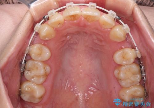 【モニター】横顔のシルエットをスッキリと ワイヤー装置による抜歯矯正治療の治療中