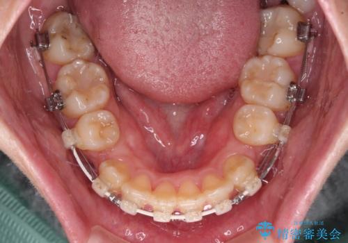 【モニター】横顔のシルエットをスッキリと ワイヤー装置による抜歯矯正治療の治療中