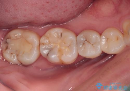 奥歯のむし歯治療　セラミックインレーの治療前