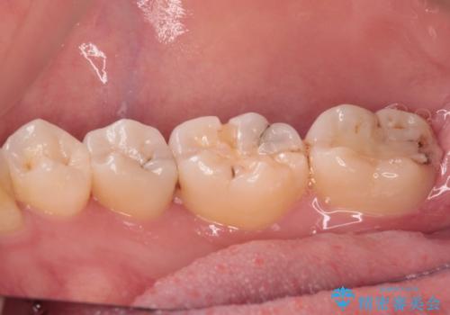 奥歯のむし歯治療 セラミックインレーの治療前