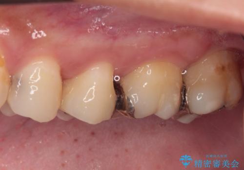 奥歯のむし歯治療 セラミックインレーの治療前