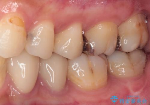 奥歯のむし歯治療 セラミックインレーの治療前