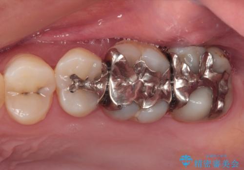 奥歯のむし歯治療 セラミックインレーの症例 治療前