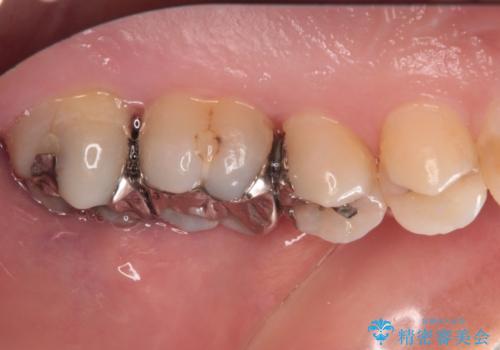 奥歯のむし歯治療 セラミックインレーの治療前