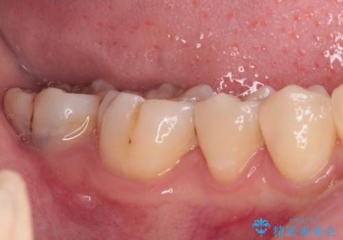 奥歯のむし歯治療 セラミックインレーの治療前