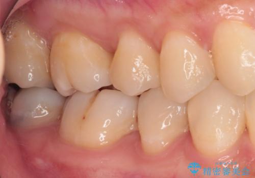 奥歯のむし歯治療 セラミックインレーの治療前