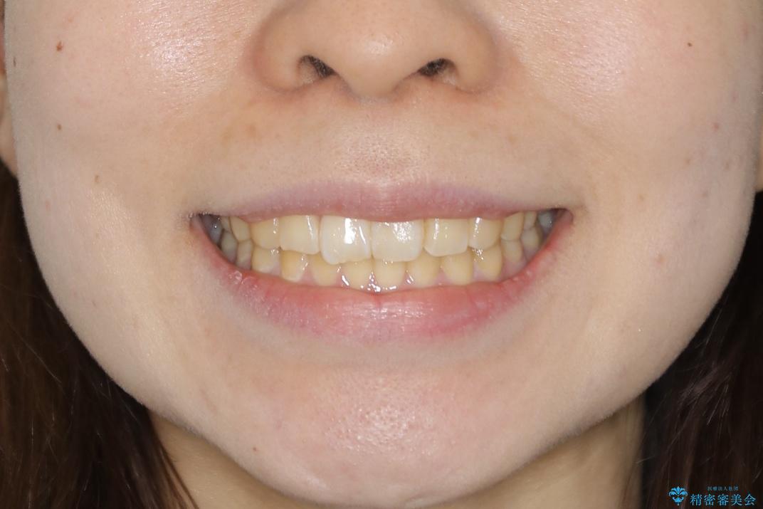 【非抜歯】ガタつきと歯軸を正して長持ちする歯への治療後（顔貌）