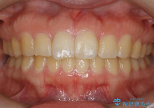 【非抜歯】ガタつきと歯軸を正して長持ちする歯への症例 治療後