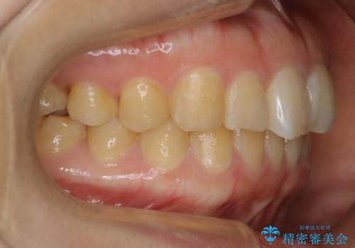【非抜歯】ガタつきと歯軸を正して長持ちする歯への治療後
