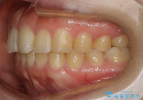 【非抜歯】ガタつきと歯軸を正して長持ちする歯への治療後