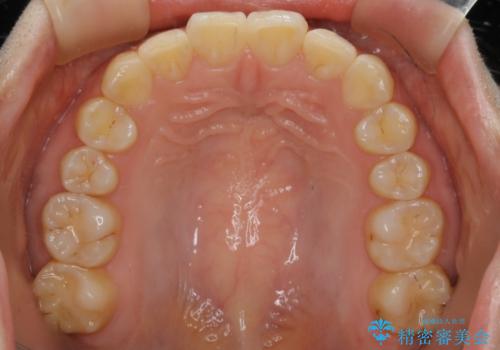 【非抜歯】ガタつきと歯軸を正して長持ちする歯への治療後