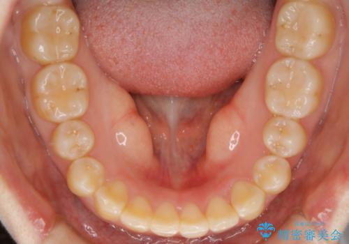 【非抜歯】ガタつきと歯軸を正して長持ちする歯への治療後