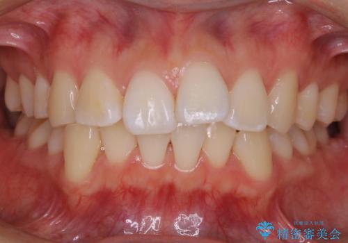 【再矯正】後戻りによるガタつきをマウスピースで改善!の治療前