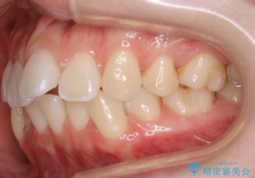 【再矯正】後戻りによるガタつきをマウスピースで改善!の治療前