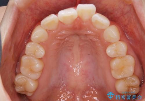 【再矯正】後戻りによるガタつきをマウスピースで改善!の治療前