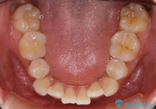 【再矯正】後戻りによるガタつきをマウスピースで改善!の治療前